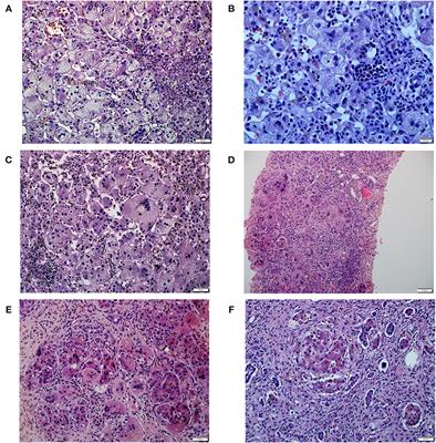 Sterol 27-Hydroxylase Deficiency as a Cause of Neonatal Cholestasis: Report of 2 Cases and Review of the Literature